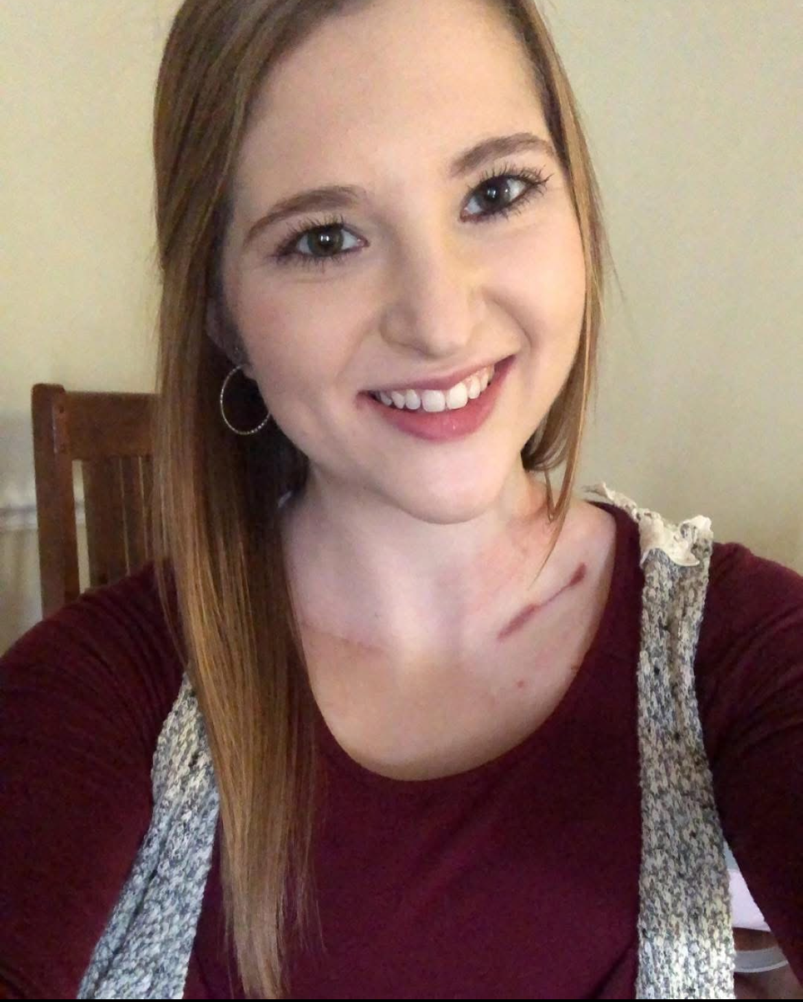 Andrea's Story - EDS Zebra Club